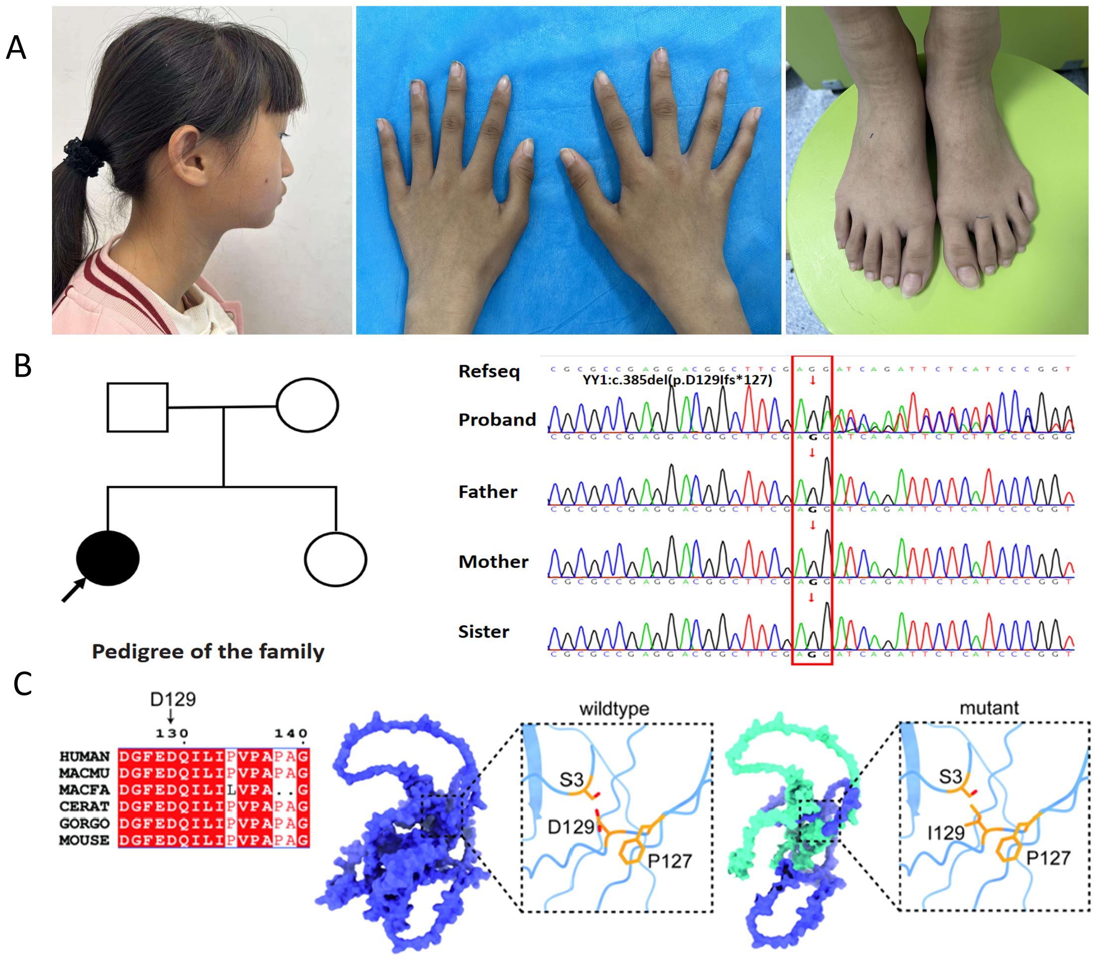Panel A shows three images: a side profile of a girl with a ponytail, her hands on a blue surface, and her bare feet on a green stool. Panel B depicts a family pedigree with genetic sequencing data for a family, highlighting a specific mutation. Panel C includes a genetic sequence alignment across species, a molecular structure with wildtype and mutant representations, focusing on residues D129 and P127.