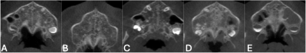 Panels labeled A to E show CBCT scans of the mid-palatal suture of the human maxilla. Difference in the midpalatal suture interdigitation are visible.