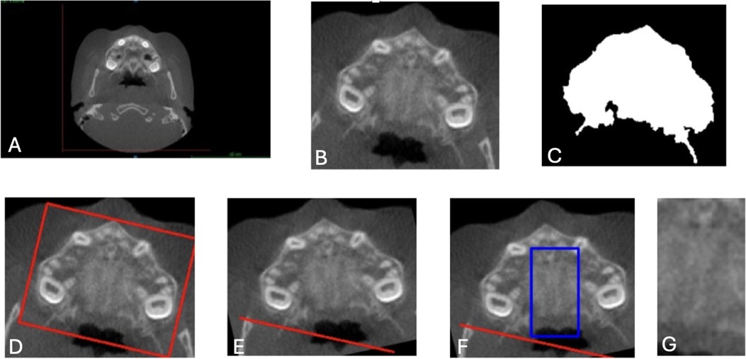 CBCT images labeled A to G. A Shows axial slice of the skull. B is a zoomed in section highlighting the palate. C is a mask of palate structure. D, E, and F display angled and demarcated sections for analysis. G presents the region of interest of the CBCT scan.