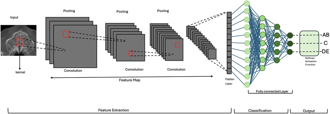 Diagram of a convolutional neural network (CNN) architecture. Features are extracted from an input medical image via convolution and pooling layers, forming a feature map. This map is flattened and passed through fully connected layers. The final output is classified using a Softmax activation function into categories labeled AB, C, and DE. The process is divided into three stages: feature extraction, classification, and output.