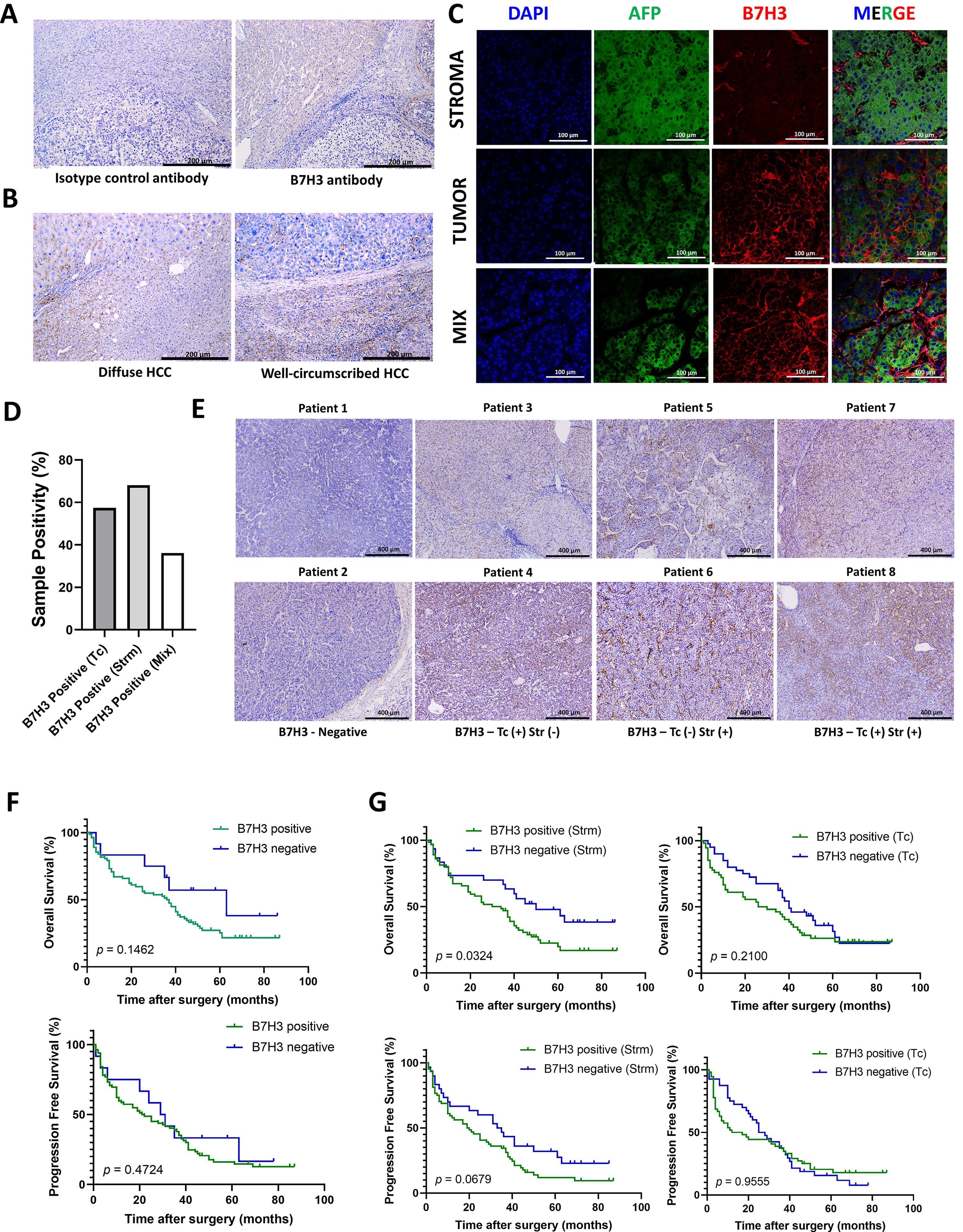 Histological analysis of hepatocellular carcinoma (HCC) using B7H3 antibody staining. Panel A shows comparison between isotype control and B7H3 antibody. Panel B illustrates diffuse and well-circumscribed HCC. Panel C displays fluorescence imaging of stroma, tumor, and mixed samples with DAPI, AFP, B7H3, and merged channels. Panel D presents a bar graph of sample positivity percentages. Panel E includes histological images of samples from eight patients with varying B7H3 expression. Panels F and G feature survival analysis graphs comparing overall and progression-free survival in B7H3-positive and negative groups over time after surgery.