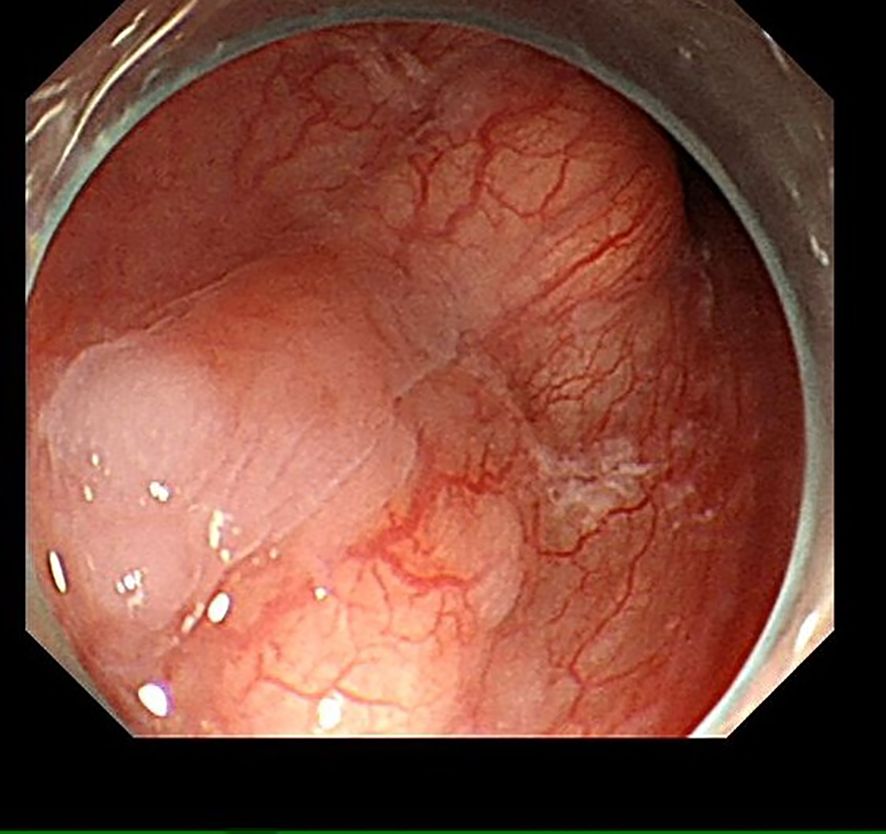 Endoscopic view of the lining of a gastrointestinal tract, displaying a reddish, tubular structure with visible blood vessels. The surface appears moist and slightly glossy.
