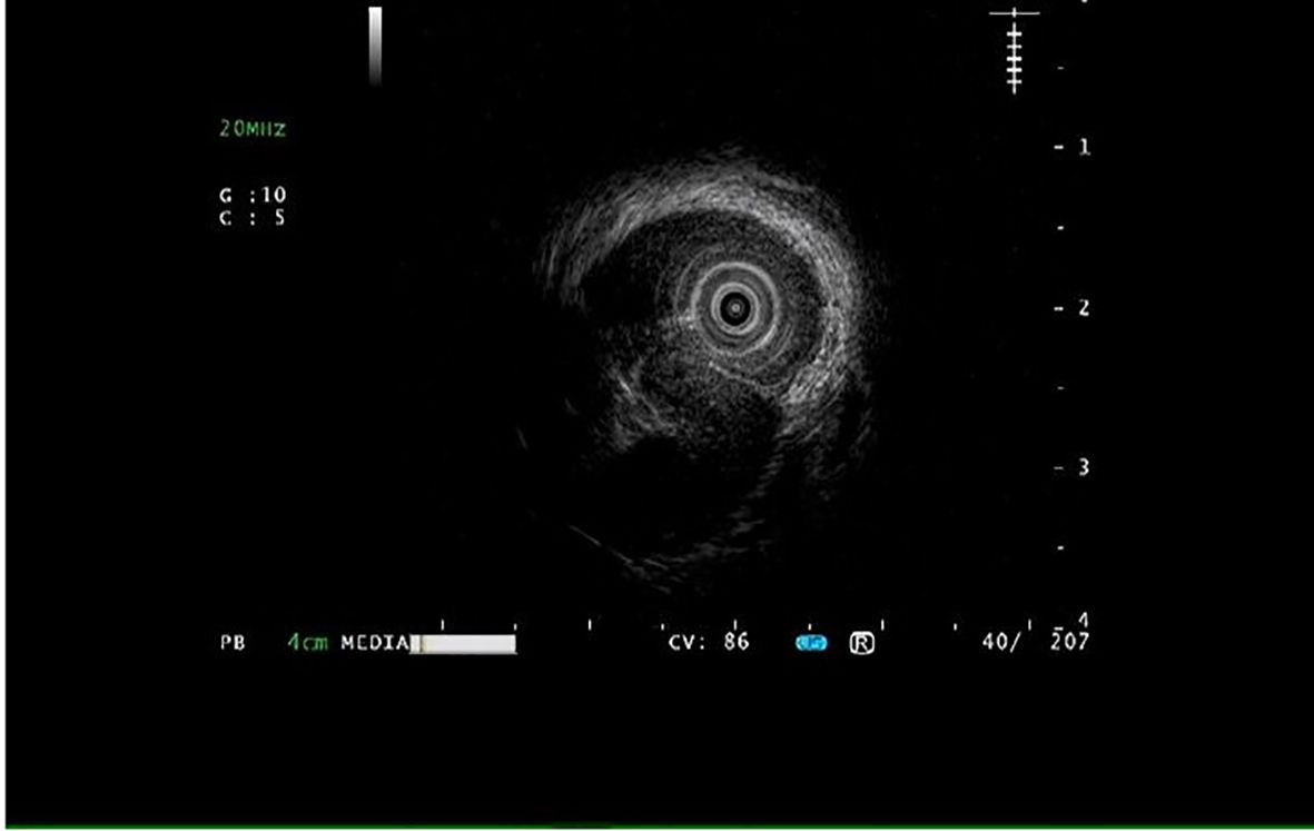 An intravascular ultrasound (IVUS) image showing a cross-sectional view of a coronary artery. The concentric rings indicate layers of the arterial wall. Measurements and settings are displayed on the screen.
