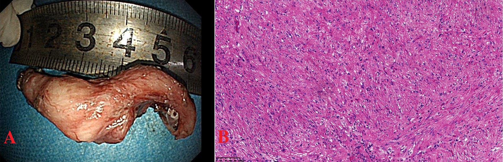 Panel A shows a resected tissue specimen next to a measuring tape, indicating it is around five centimeters. Panel B displays a microscopic view of the tissue with a pink and purple stained fibrous texture.