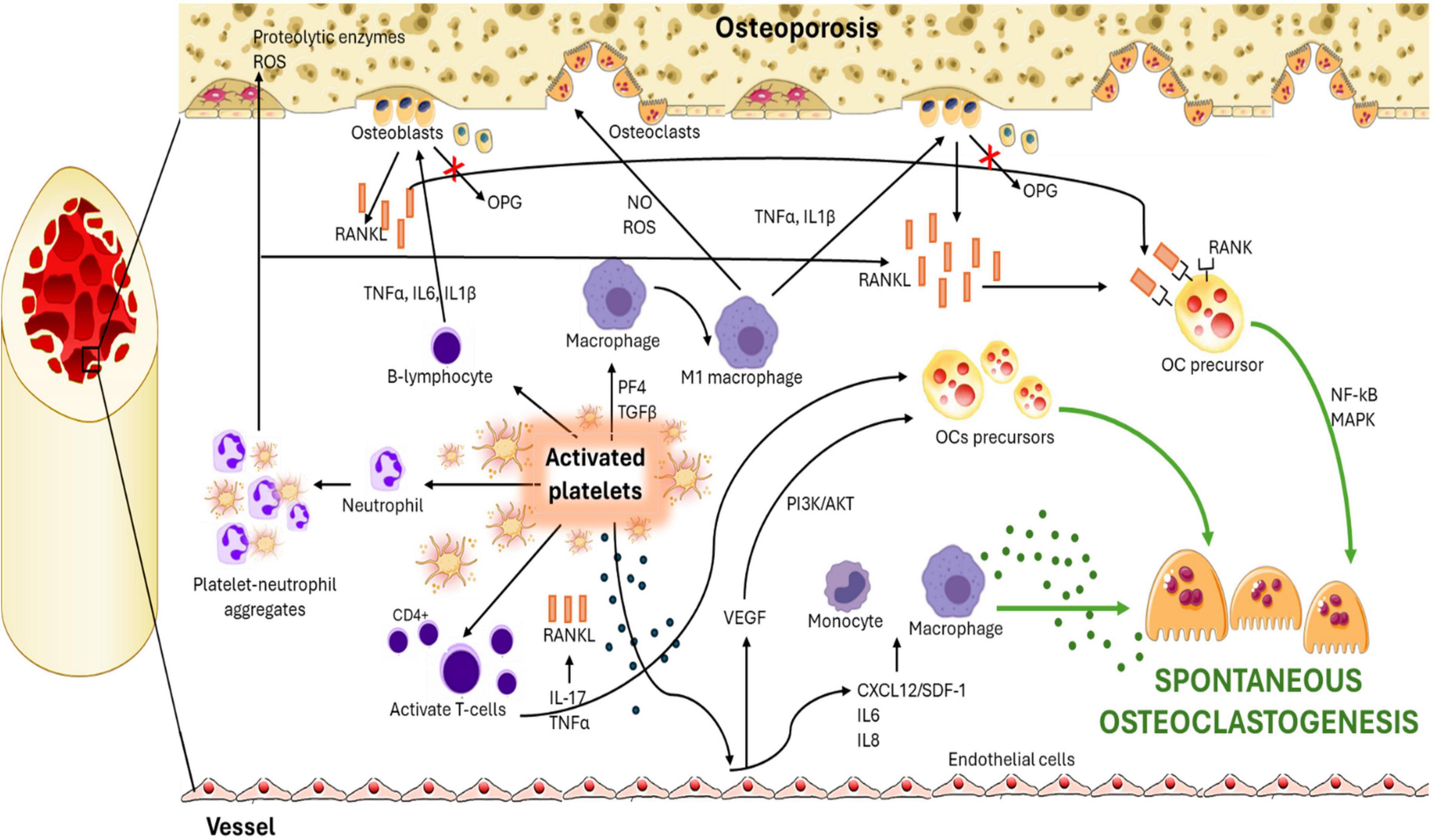 Schematic diagram illustrating the process of spontaneous osteoclastogenesis linked to osteoporosis. It depicts interactions between various cells, including osteoclasts, osteoblasts, and activated platelets. Signaling pathways, such as RANK, RANKL, TNFα, and IL1β, are shown influencing osteoclast precursors. Other factors, like VEGF, NF-kB, and MAPK, also play roles in the process within the bone microenvironment. The graphic highlights the role of inflammatory cytokines and signals in bone resorption, contributing to osteoporosis development.