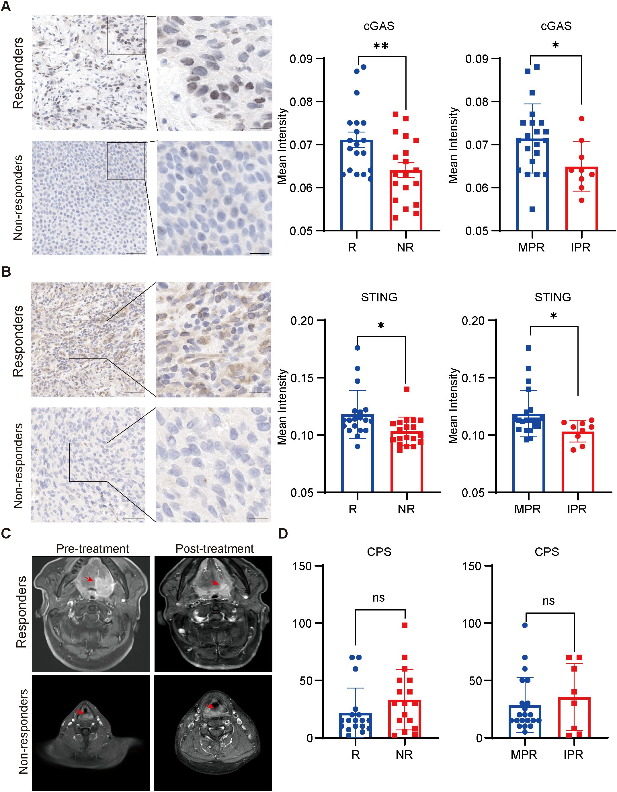 Panel A displays images and graphs of cGAS expression in tissue samples, comparing responders and non-responders. Panel B shows similar data for STING expression. Panel C includes pre-treatment and post-treatment MRI scans of responders and non-responders. Panel D features bar charts comparing CPS scores between different groups. Statistical significance is indicated in the charts.