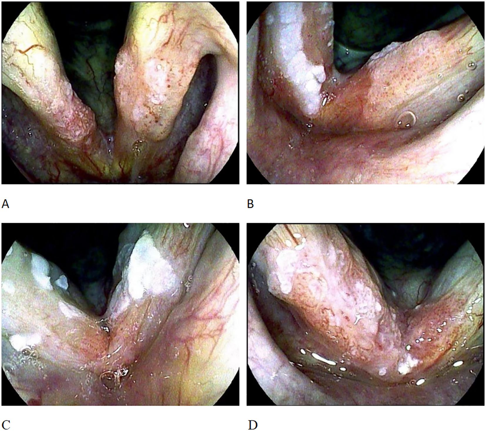 Four endoscopic images labeled A, B, C, and D show the larynx with varying degrees of redness and white patches. The images capture different angles and lighting, highlighting the vocal cords and surrounding tissue. Bubbles and light reflections are visible.
