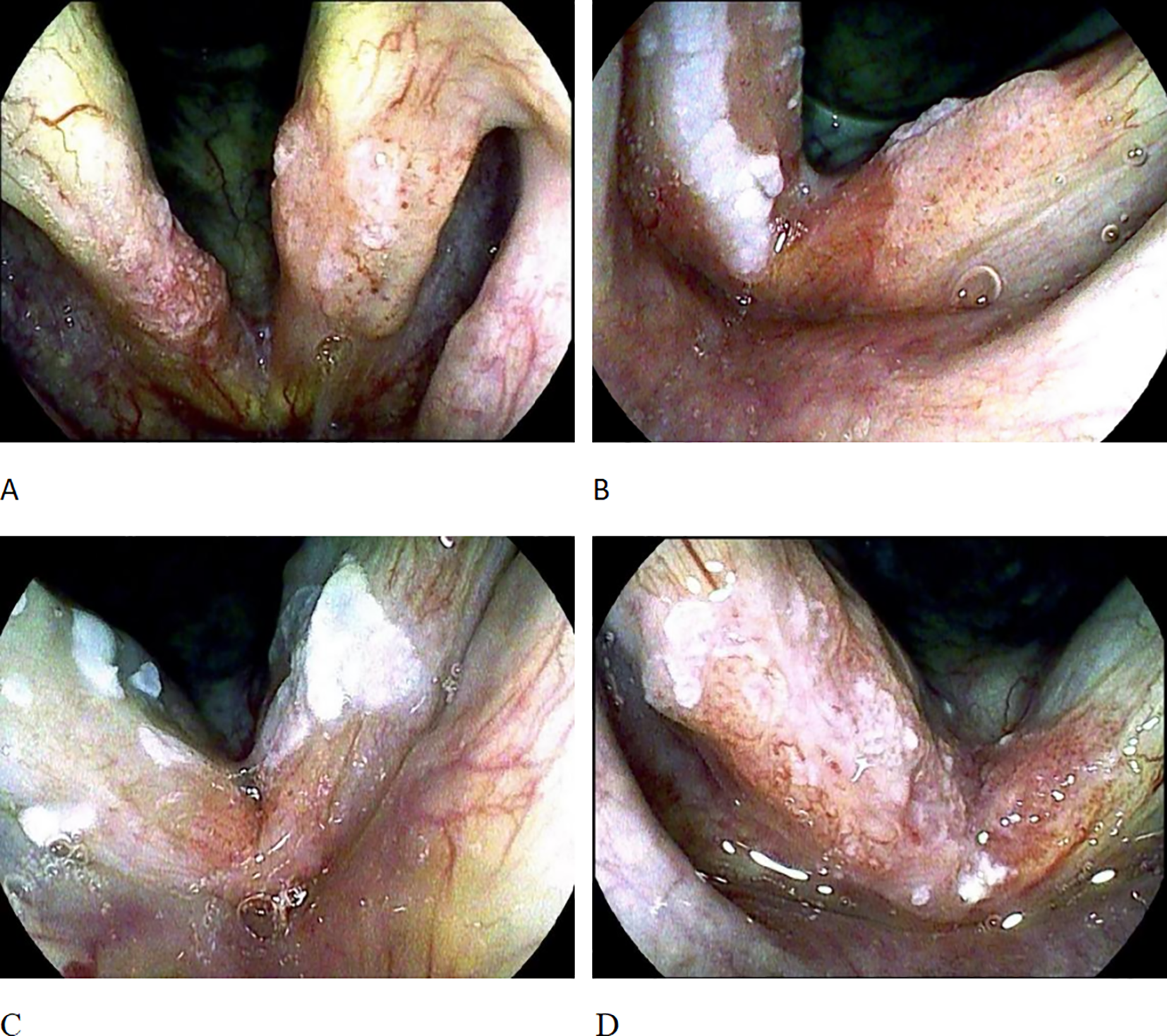 Four endoscopic images labeled A, B, C, and D show the larynx with varying degrees of redness and white patches. The images capture different angles and lighting, highlighting the vocal cords and surrounding tissue. Bubbles and light reflections are visible.