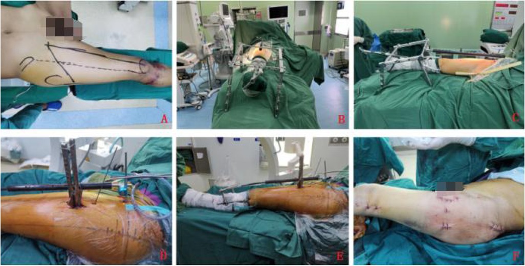 Surgical procedure images in six panels. Panel A shows pre-surgery markings on a patient's leg. Panel B and C depict the top view and side view of patient on an operating table with lower extremity axial bone traction equipment. Panel D shows a close-up of surgical instruments used. Figure E depicts the lower limb mechanical alignment during the surgical procedure. Figure F displays the appearance of the surgical wound postoperatively.