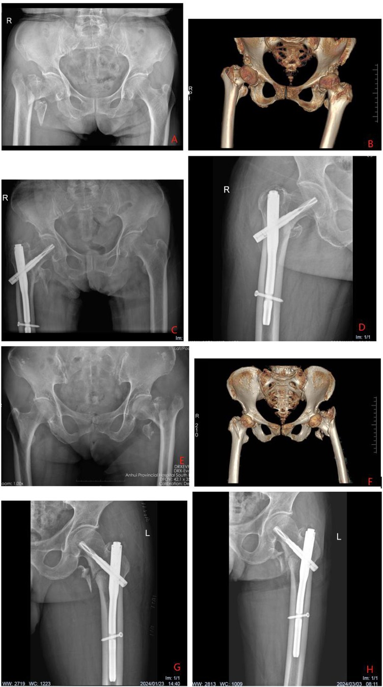 Radiographic and 3D images demonstrate the intertrochanteric femoral fracture and subsequent fixation. Images A and E display the initial pelvic fracture. Images B and F present 3D reconstructions of the hip joint. Figures C, D, G, and H illustrate the stabilization of the intertrochanteric fracture using surgical implants.