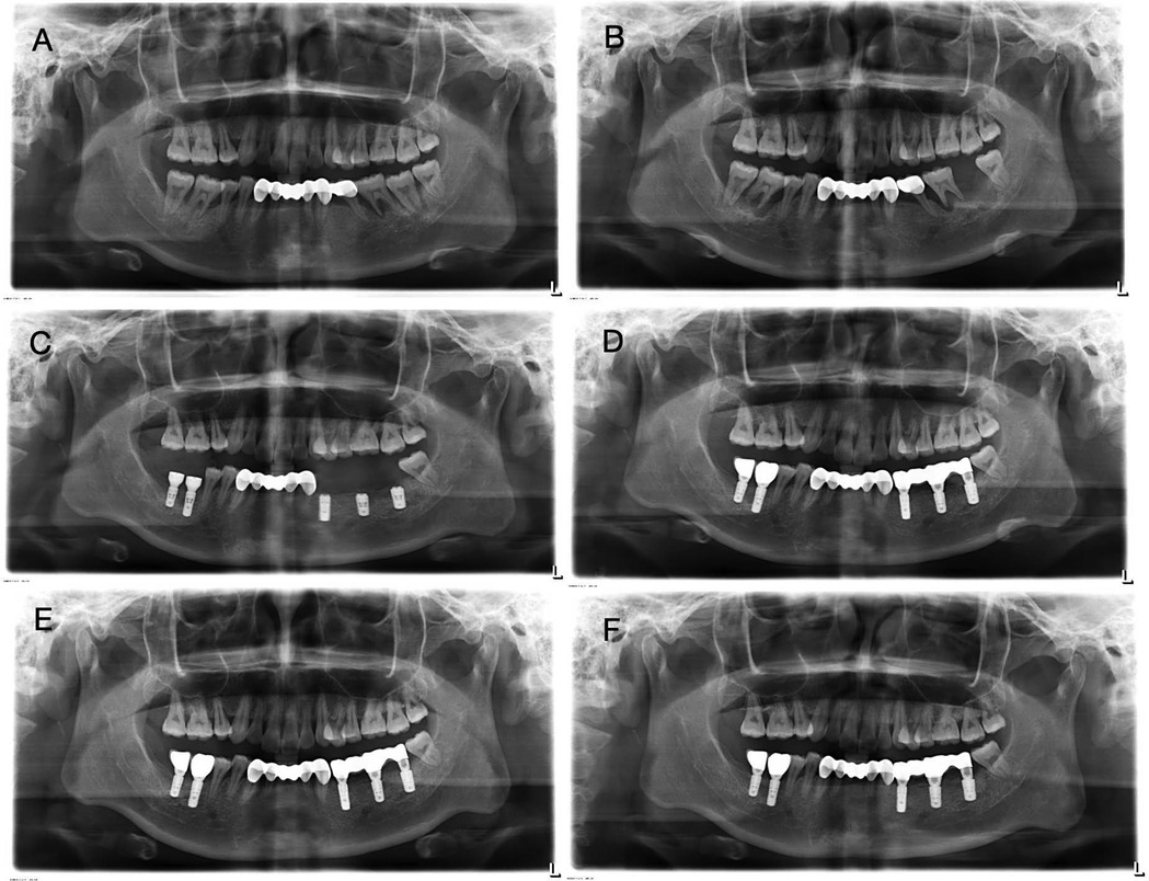 Six-panel image of dental X-rays labeled A through F, showing panoramic views of teeth. Each panel illustrates different stages of dental implant procedures with various numbers and positions of implants and natural teeth. Panels A and B show fewer dental modifications, while panels C through F display increased numbers of implants.