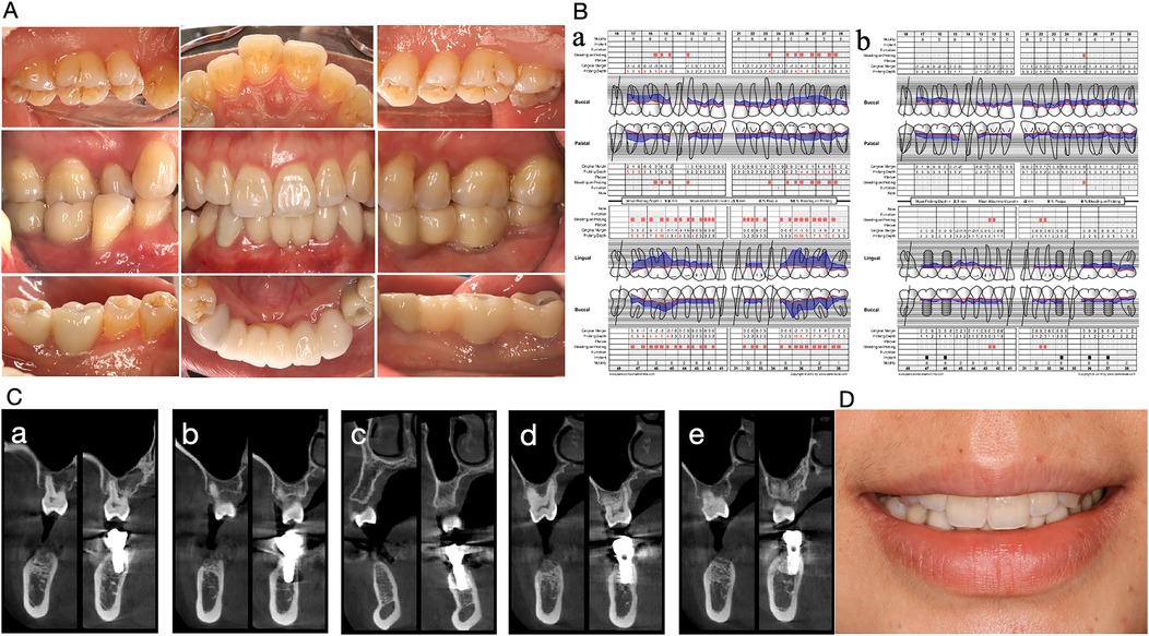 Panel A shows a series of intraoral photographs taken from different angles to illustrate tooth alignment and occlusion after treatment. Panel B shows a periodontal chart, labeled a and b, showing detailed measurements of probing depth, clinical attachment level, and bleeding on probing for each tooth before and after treatment, respectively. Panel C includes five pairs of cone-beam computed tomography (CBCT) scans (a-e) showing longitudinal bone changes and implant positioning in the mandibular region. Panel D shows a close-up photograph of a person's smile, displaying the esthetic outcome of dental treatment with aligned and healthy-looking anterior teeth.