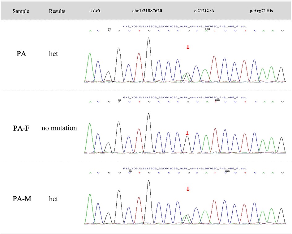 Genetic sequence data showing electropherograms for three samples labeled PA, PA-F, and PA-M, corresponding to the ALPL gene mutation c.212G>A on chr1:21887620, resulting in the p.Arg71His change. Sample PA and PA-M are heterozygous (