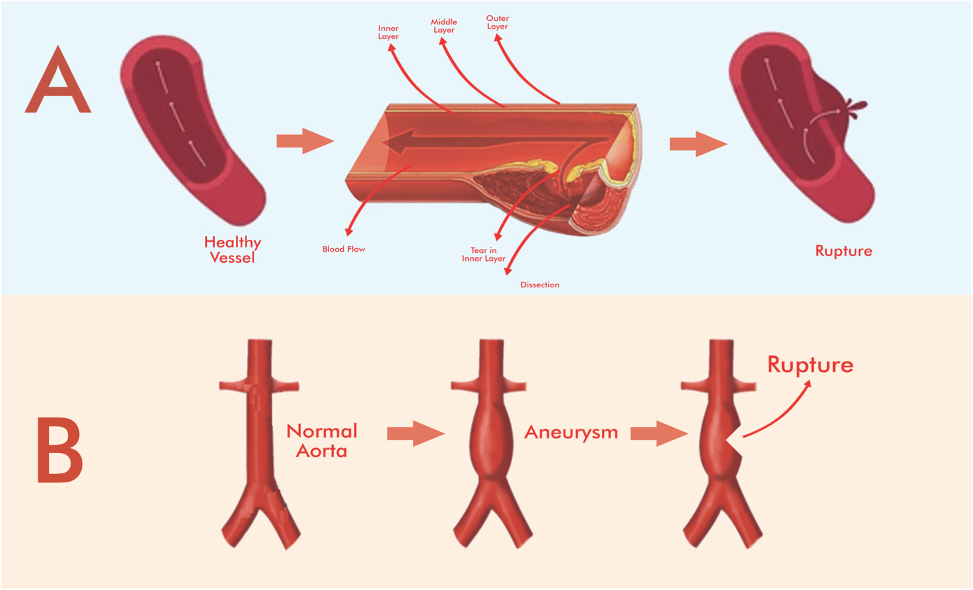 Diagram showing two parts: A) Cross-section of a blood vessel illustrating progression from healthy vessel to rupture due to inner layer tear and dissection. B) Sequence of aorta changes from normal to aneurysm, leading to rupture.
