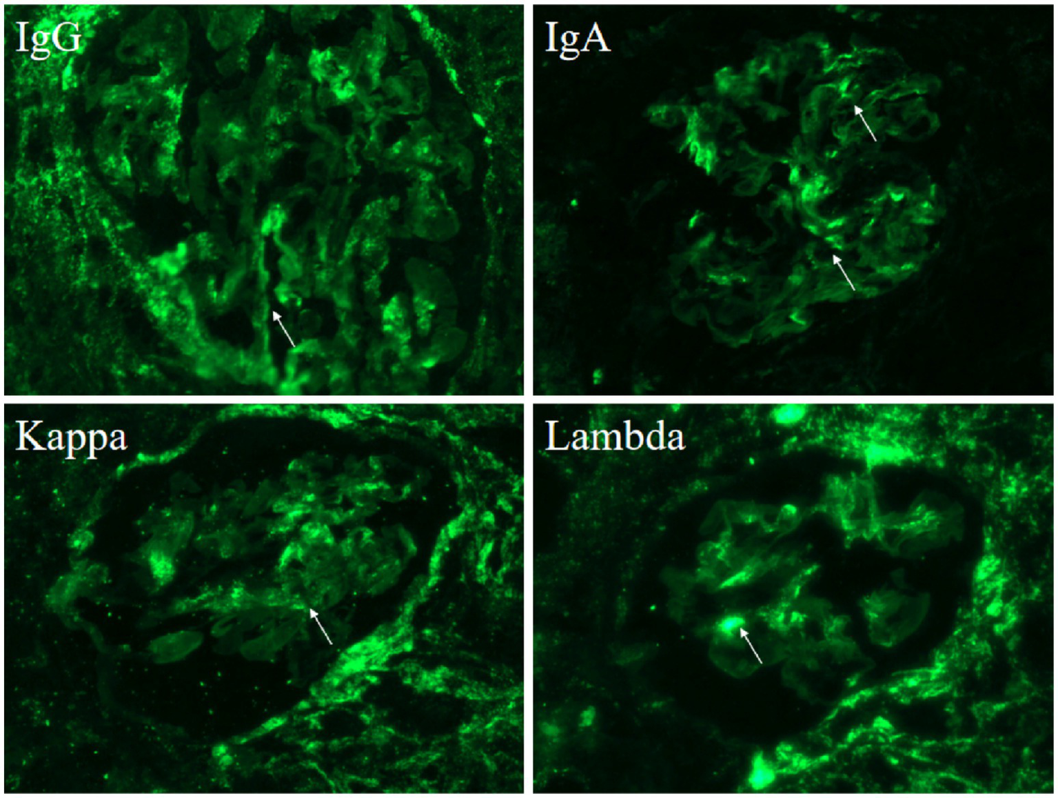 Fluorescent microscopy images showing immunofluorescence staining of kidney tissue. Top left panel labeled "IgG" displays green fluorescence with marked areas indicated by arrows. Top right panel labeled "IgA" shows similar staining pattern. Bottom left labeled "Kappa" and bottom right labeled "Lambda" exhibit green fluorescence with arrows highlighting specific areas.