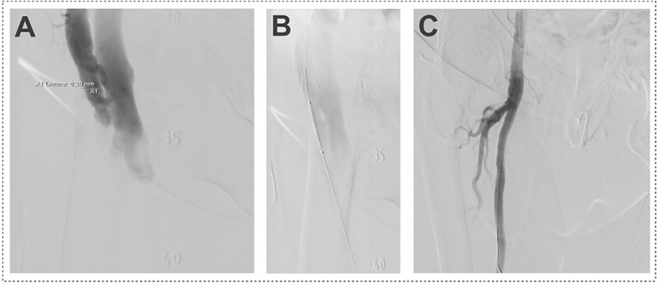 Three-panel angiographic image: (A) shows AV-fistula between femoral artery and femoral vein; (B) depicts a covered stents implanted in the femoral artery above AV-fistula; (C) illustrates successful treatment of AV-fistula without residual flow between artery and vein.