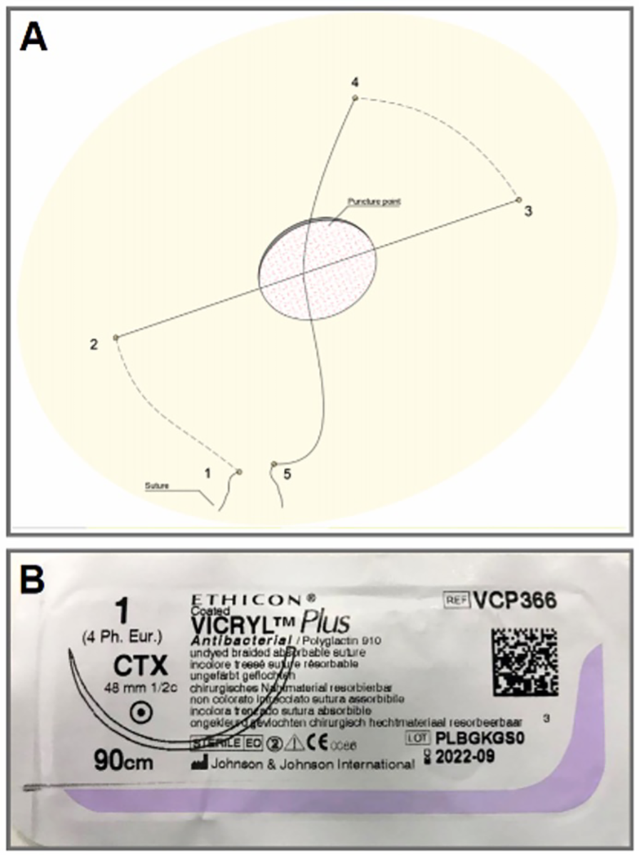 Diagram labeled \"A\" shows a suture path with puncture points around an elliptical shape, indicating a stitching process. Image \"B\" is the packaging of Ethicon Vicryl Plus antibacterial, a 90 cm undyed braided absorbable suture with a 48 mm needle, featuring a QR code.