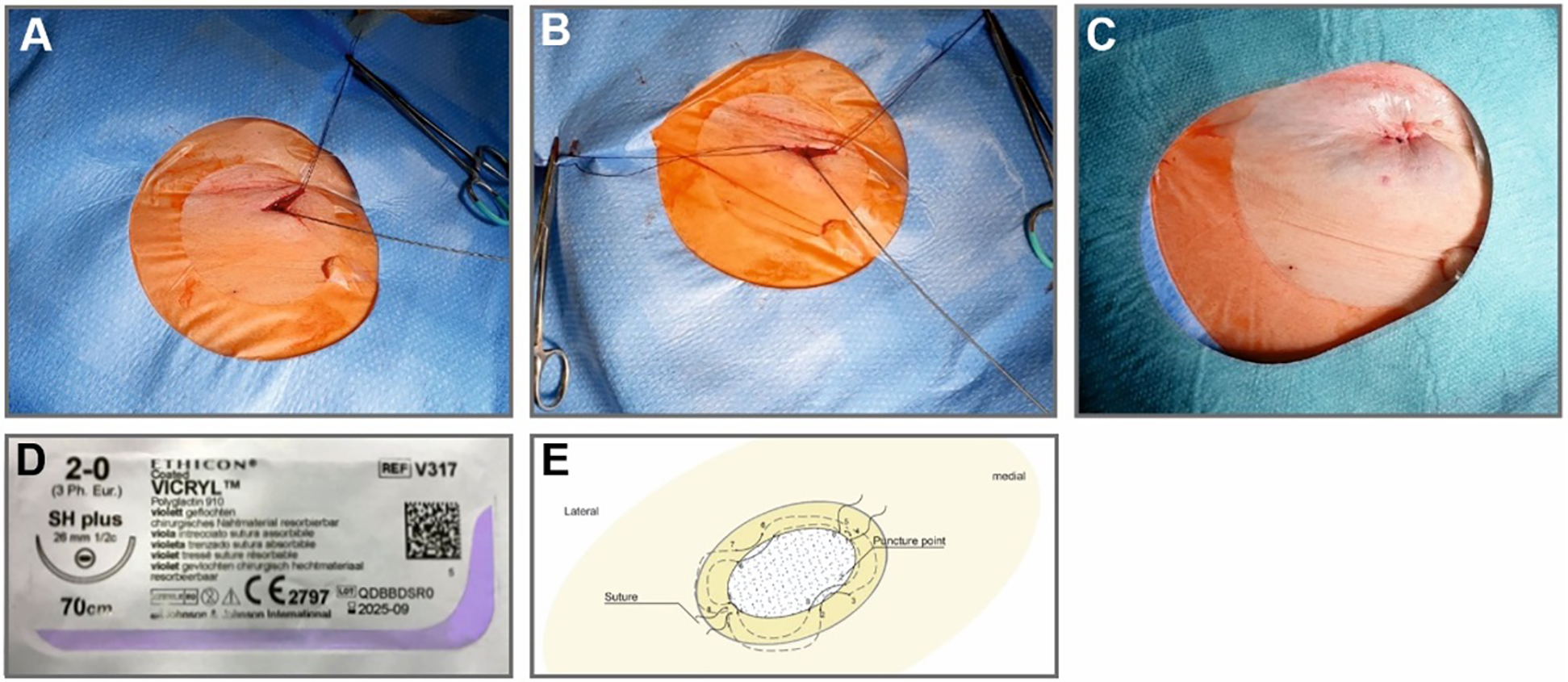 Panel A shows a surgical site with sutures in an orange-tinted area. Panel B presents a continuation of suturing in a similar setting. Panel C displays the completed suture. Panel D shows the packaging of a purple thread suture labeled Vicryl 2-0, 70 cm. Panel E is a diagram illustrating the suture placement around a puncture point, labeled with lateral and medial directions.