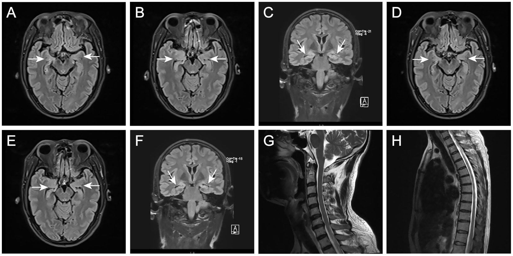 MRI scans of the brain and spine showing different views. Images A, B, D, and E are axial brain scans indicating specific areas with arrows. Images C and F are coronal views of the brain, also highlighting areas with arrows. Image G shows a sagittal view of the cervical spine, while image H presents a sagittal view of the thoracic spine.