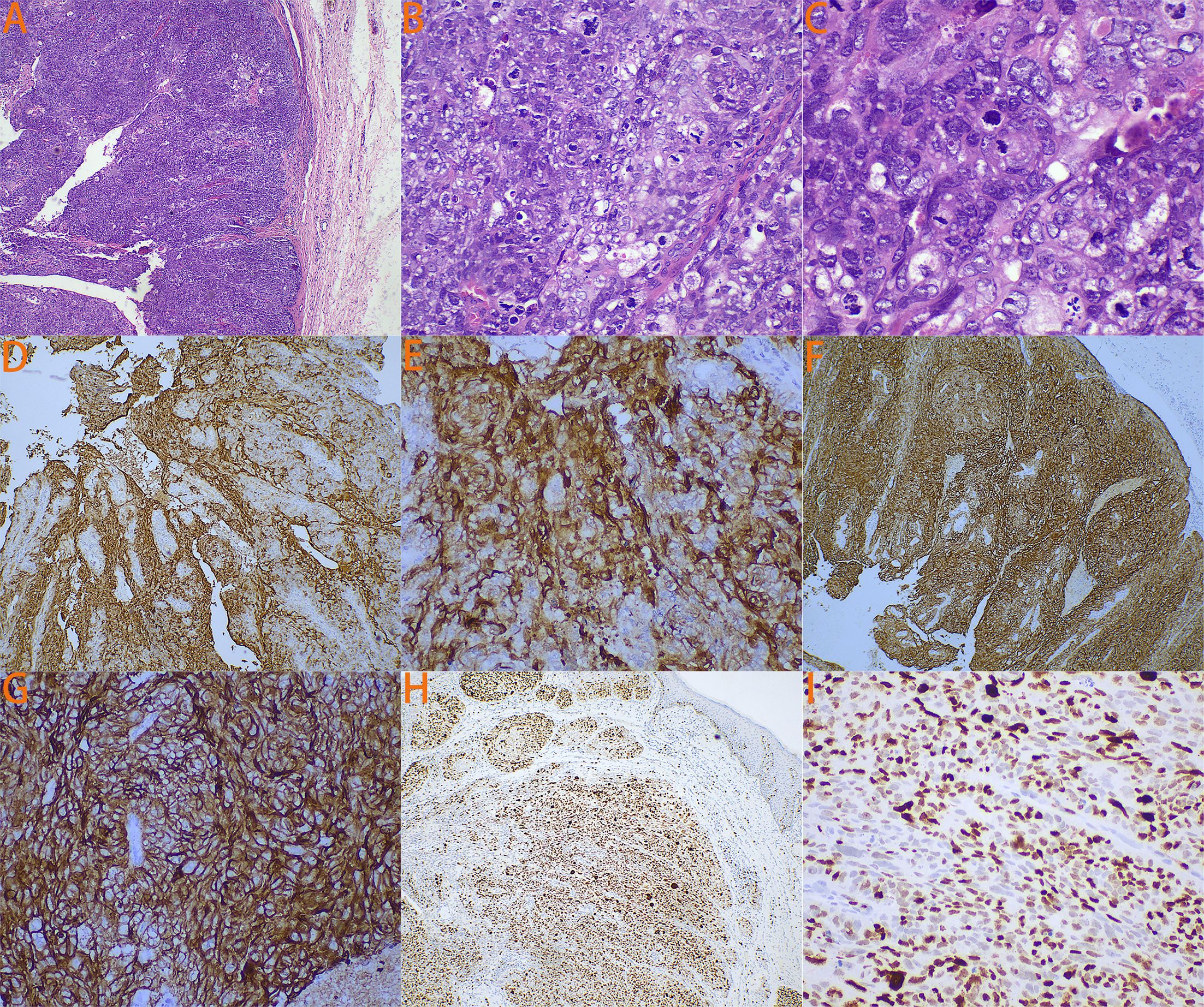 Microscopic images A through I depicting various stained tissue samples. Images A, B, and C show dense clusters of cells with varying intensity. Images D through G exhibit brown-stained tissues, highlighting specific cellular components. Image H depicts a circular cell formation with a light brown stain at the center. Image I shows scattered dark-stained nuclei on a lighter background.