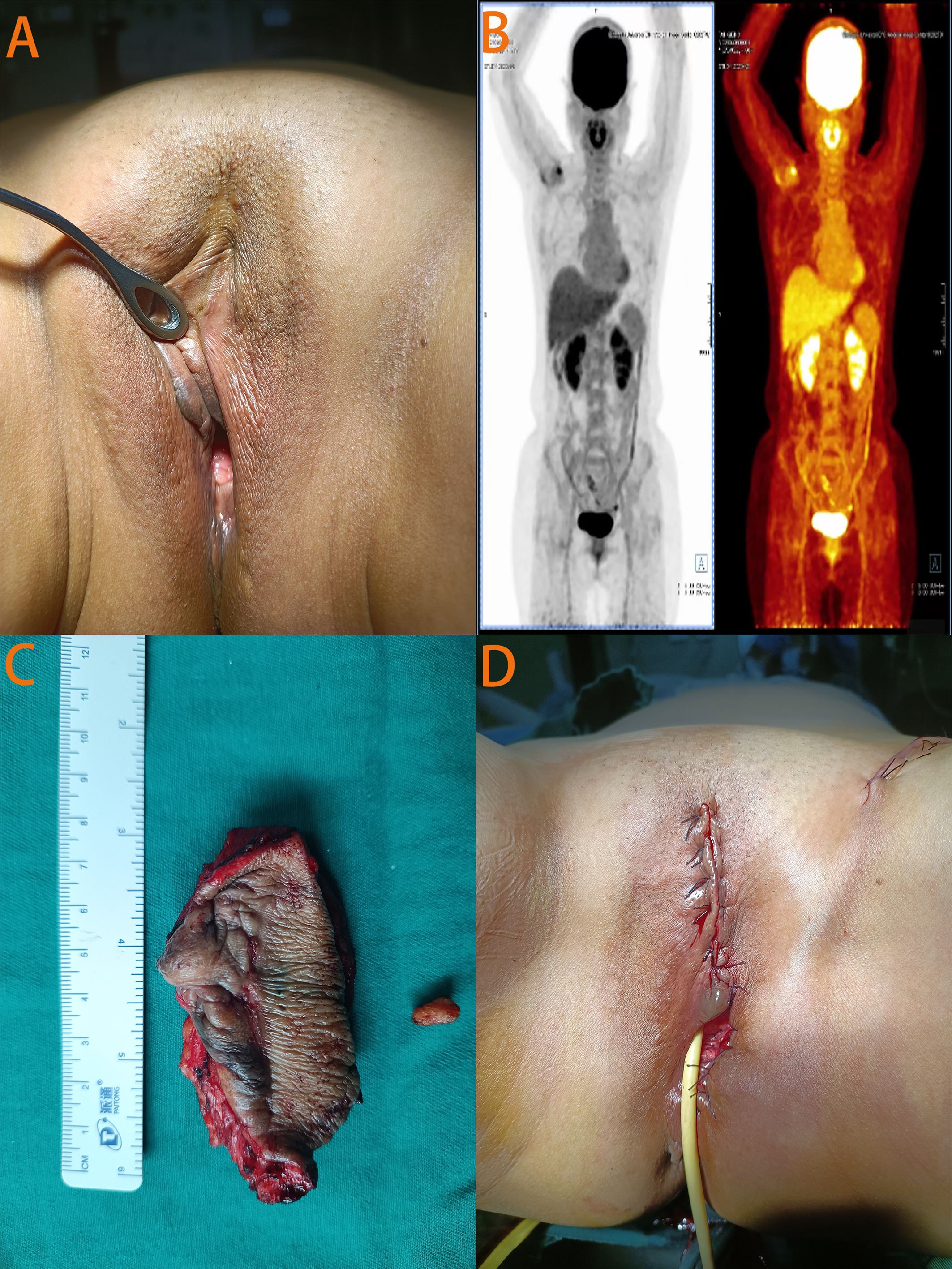 Image showing four panels related to a medical procedure. Panel A: Close-up of an anatomical feature, possibly part of a surgical site. Panel B: Two PET scan images displaying the front view of a human figure, one grayscale and one color-coded. Panel C: A removed tissue specimen placed next to a ruler for scale. Panel D: Post-surgical image showing a stitched incision with a drainage tube attached.