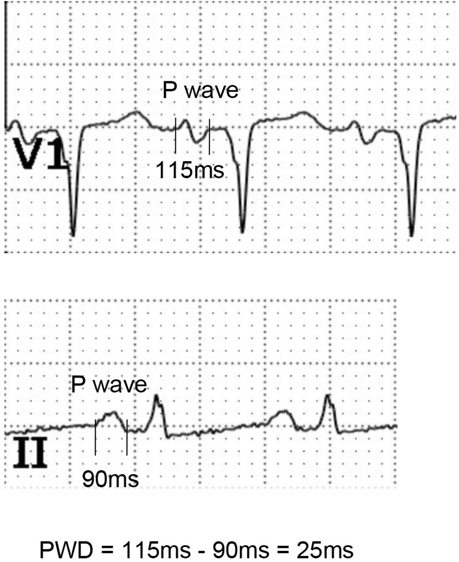 Electrocardiogram showing lead V1 with P wave duration of 115 milliseconds and lead II with P wave duration of 90 milliseconds. Calculated P wave dispersion is 25 milliseconds.