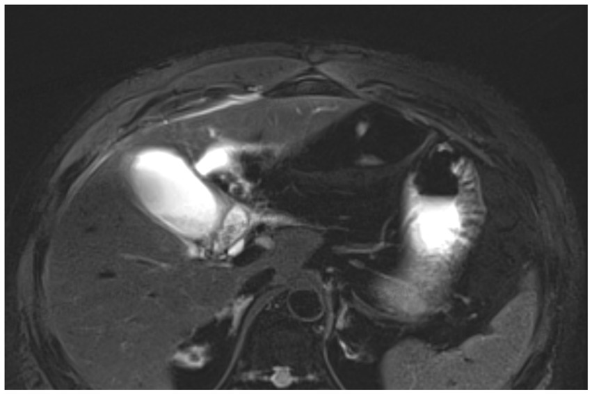 MRI scan shows a cross-sectional view of the abdomen with distinct areas of varying brightness. Dark and light regions contrast, highlighting internal structures and tissues.