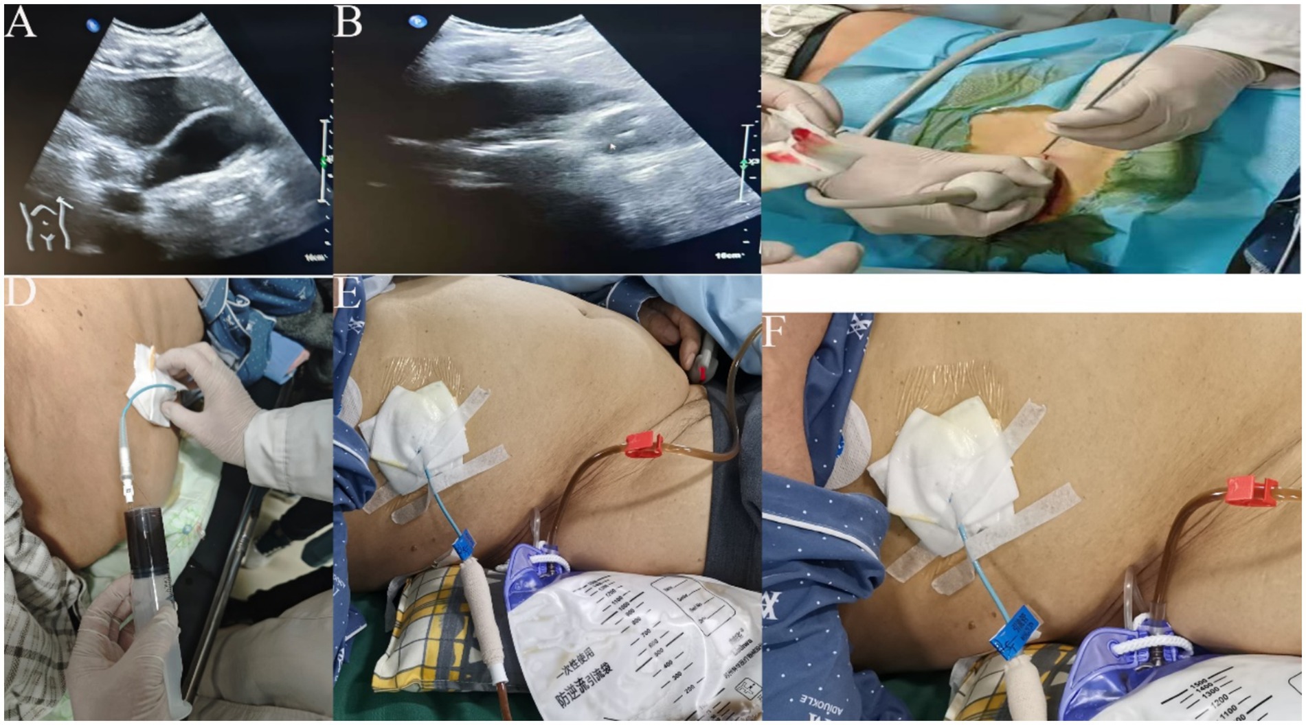 Medical procedure series showing ultrasound images and steps for draining fluid. Panel A and B display ultrasound scans, while C depicts needle insertion into tissue. Panels D, E, and F illustrate cannula insertion, fluid collection, and secured drainage setup, respectively.