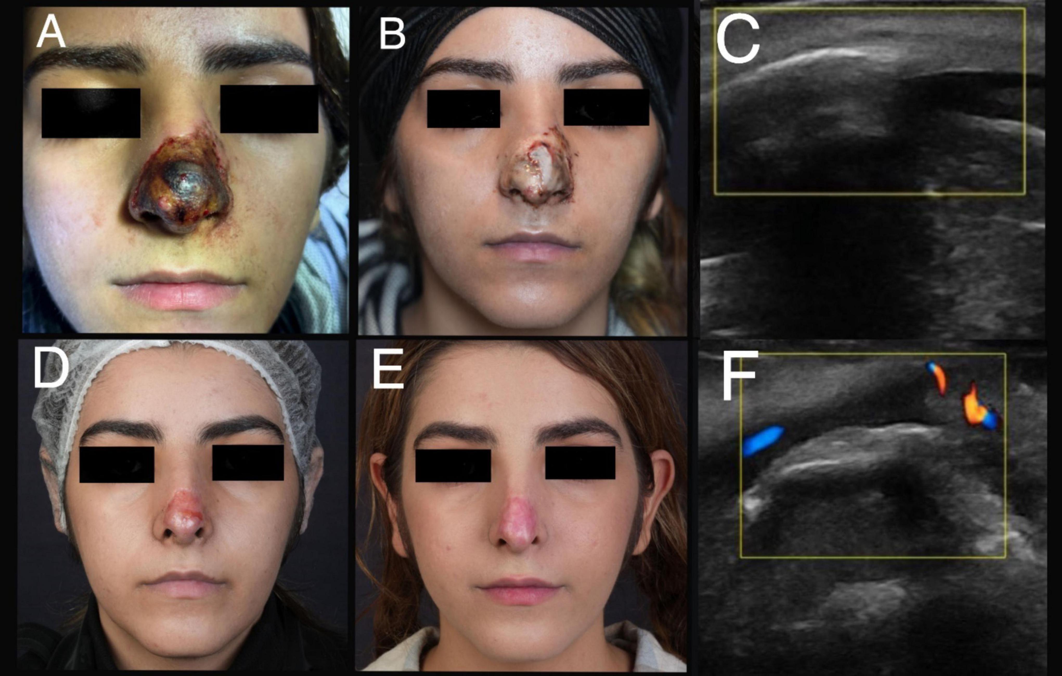 Panel of images showing stages of nose recovery and ultrasound scans. Images a, b, d, and e depict frontal views of a person’s face with progressive healing of a nose wound. Images c and f are ultrasound images, with c showing the nasal structure before treatment with artery involvement and f showing a Doppler ultrasound with color flow indicating blood movement after treatment.