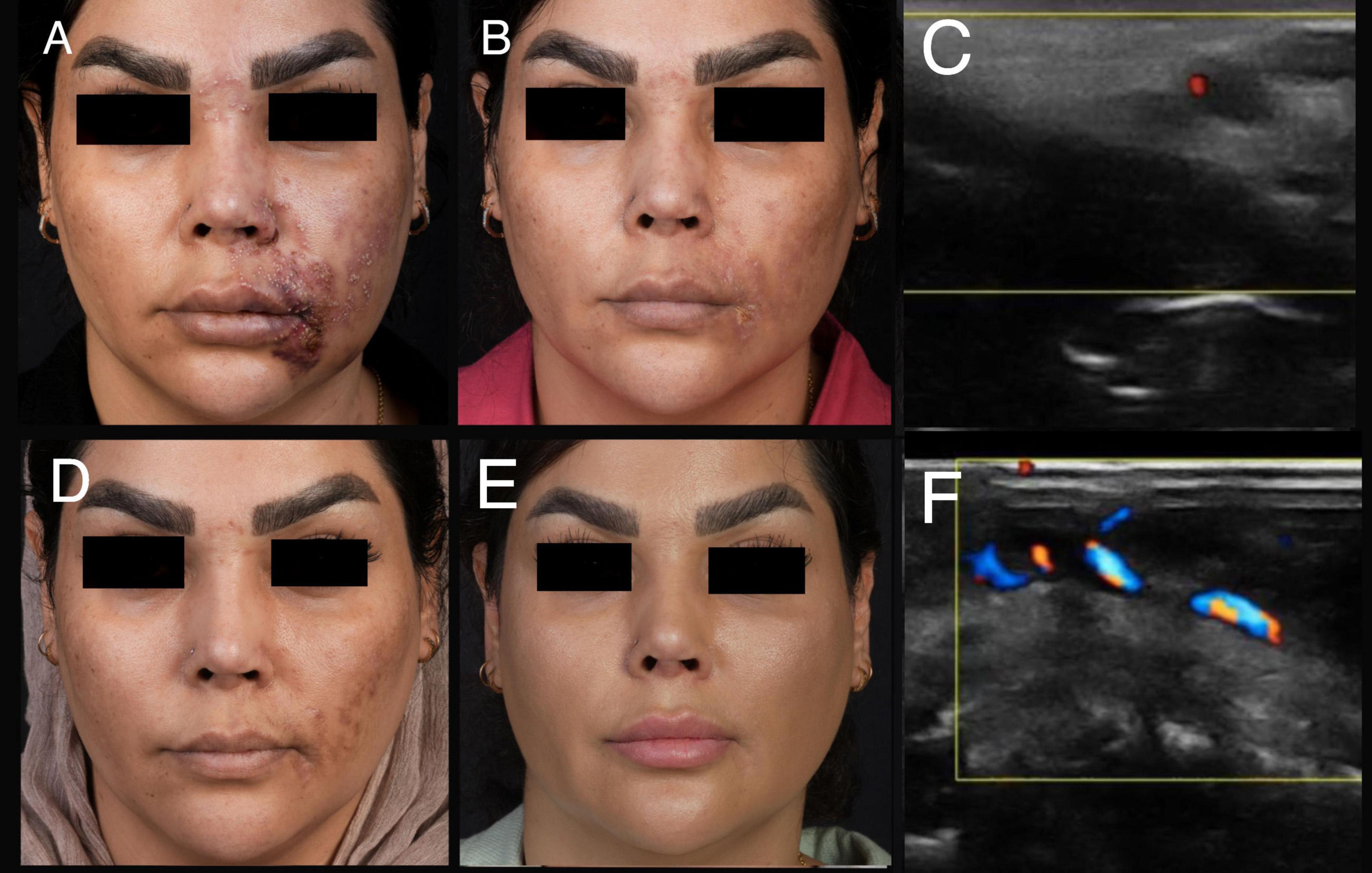 A series of face images labeled A, B, D, and E show different stages of facial improvement or treatment, with visible scars in A and smoother skin in E. Image C is an ultrasound with minimal activity, while image F shows increased activity with colored markers after treatment.