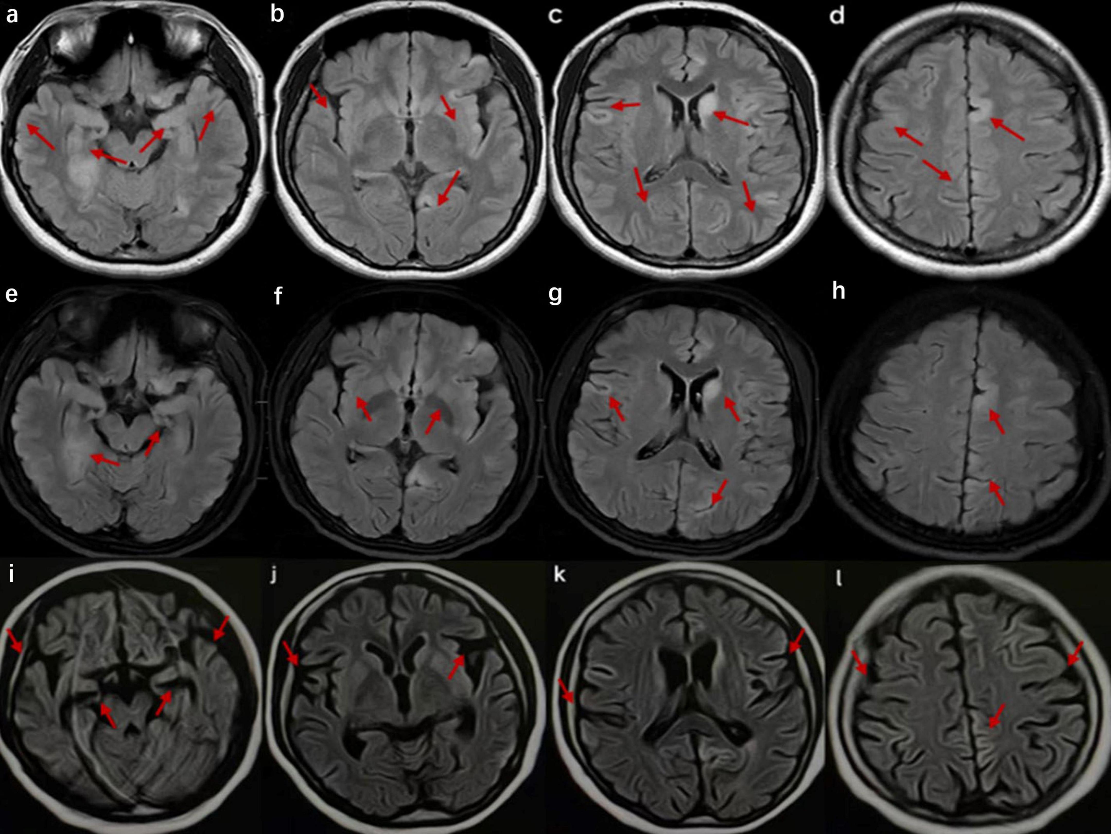 Twelve MRI brain scans labeled a to l, each showing different cross-sectional views. Red arrows highlight specific areas of interest in each image, indicating potential abnormalities or points of focus.