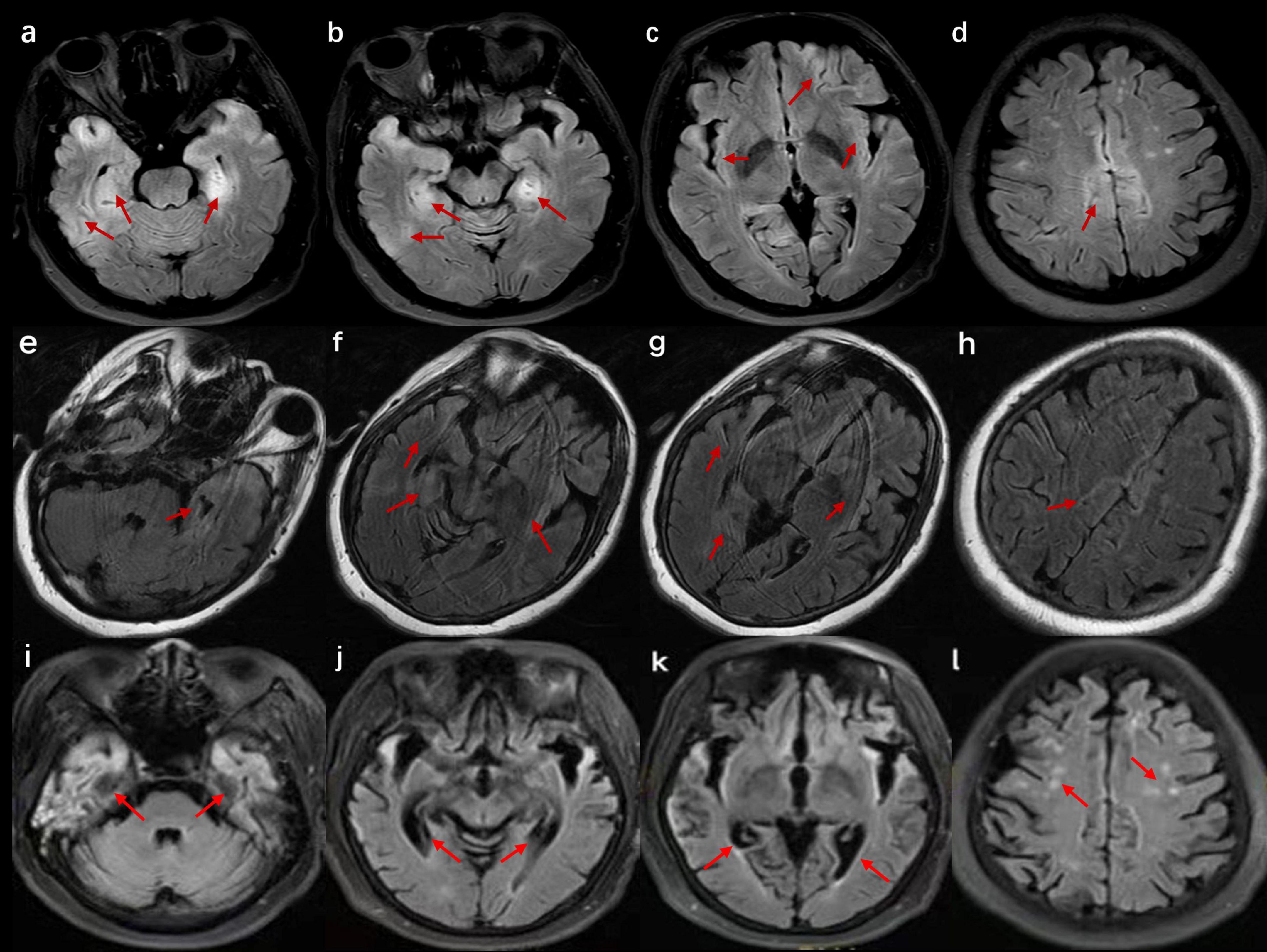 Twelve-panel MRI images of the brain labeled a to l with red arrows indicating specific areas of interest in each image. Different cross-sectional views show various brain regions, highlighting abnormalities or points of significance across different planes and sections.
