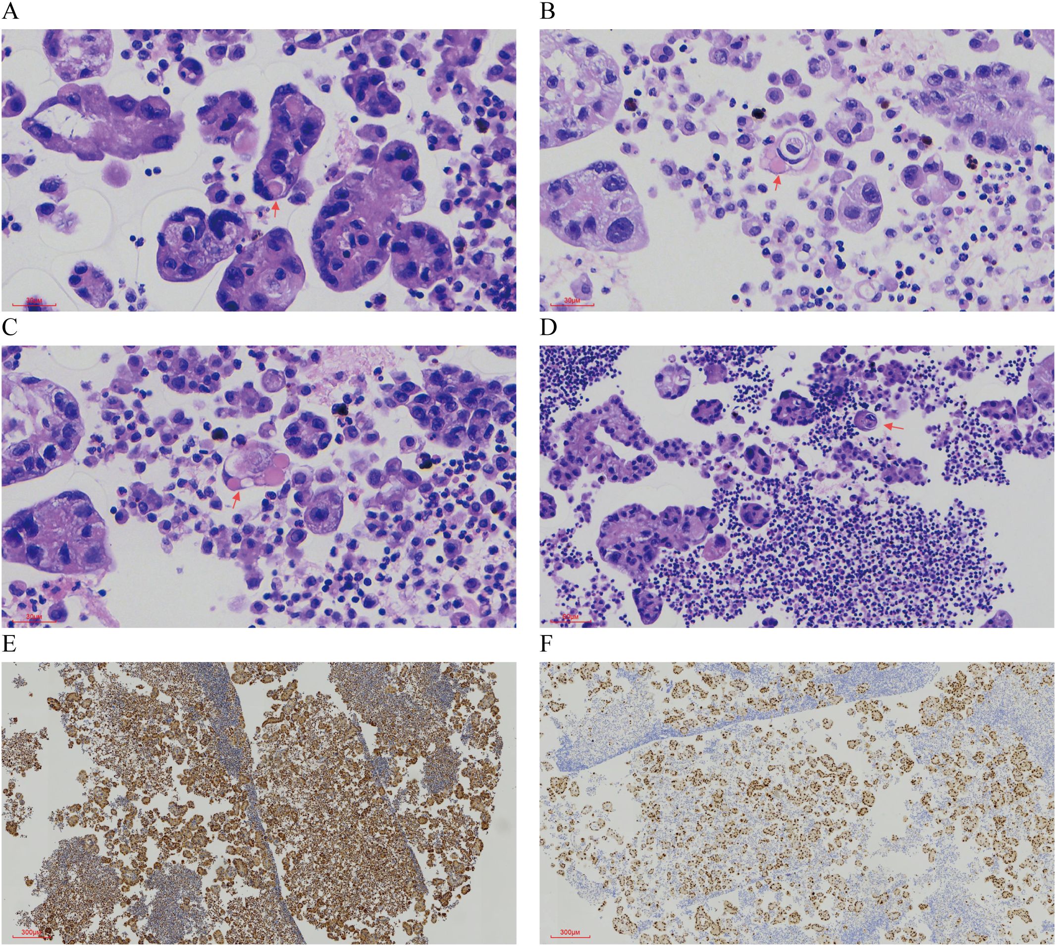 Microscopic images consisting of six panels (A to F) showing various stained cell samples. Panels A to D display purple-stained cells with varying densities and structures, with some marked by red arrows. Panels E and F show brown-stained cell samples, highlighting different patterns and distributions. Each panel provides a unique view of cellular morphology and staining techniques.