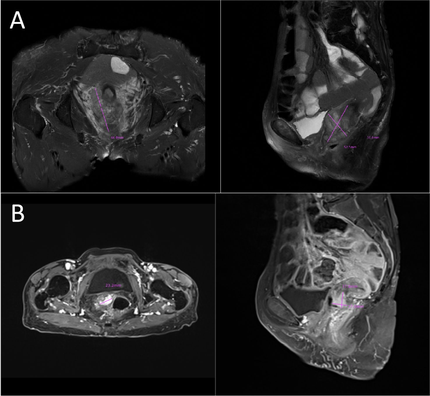 Two MRI scans, labeled A and B, each showing transverse and sagittal views. Image A displays measurements of 64 millimeters and 39.6 millimeters. Image B includes measurements of 23.2 millimeters and 22 millimeters.