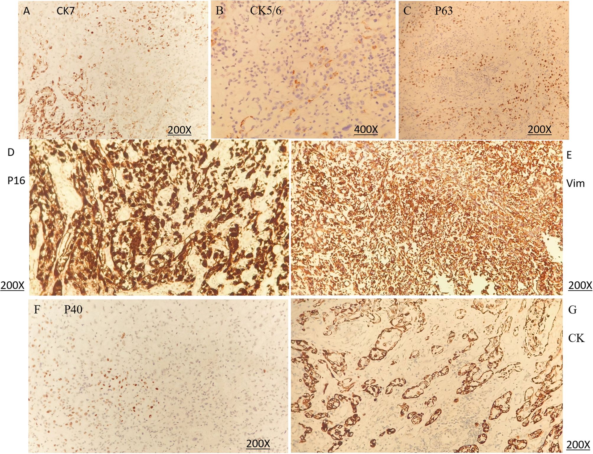 Composite image showcasing seven histological slides labeled A to G. Each slide displays different immunohistochemical stains of tissues. Slide A: CK7 at 200x magnification. Slide B: CK5/6 at 400x magnification. Slide C: P63 at 200x magnification. Slide D: P16 at 200x magnification. Slide E: Vim at 200x magnification. Slide F: P40 at 200x magnification. Slide G: CK at 200x magnification. Each slide reveals varying levels of staining intensity and cellular patterns.