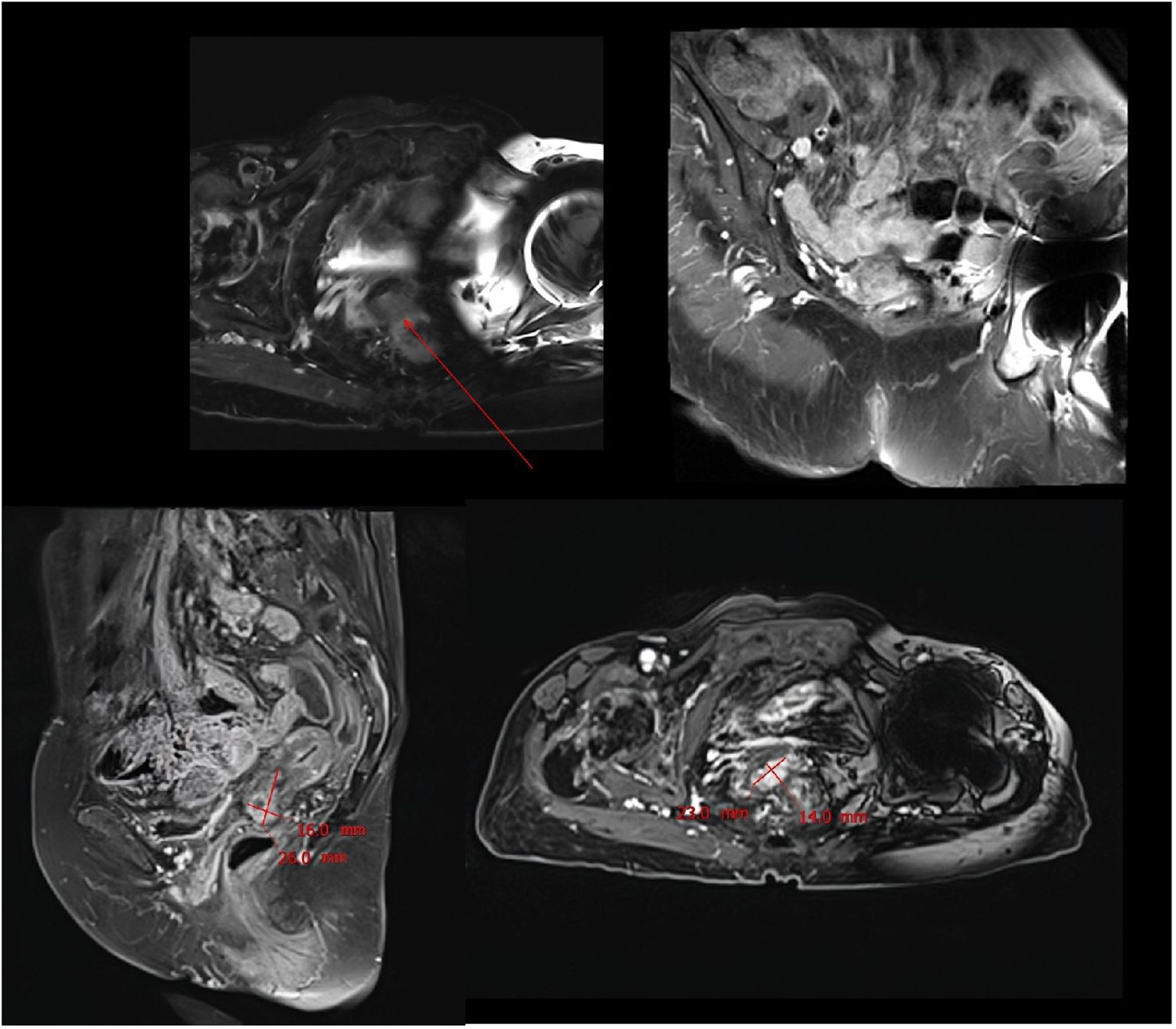 MRI scans displaying different views of pelvic anatomy. Four panels show cross-sectional images with varying orientations, highlighting internal structures. Red lines and measurements are marked on some images, possibly indicating areas of interest or concern for medical analysis.
