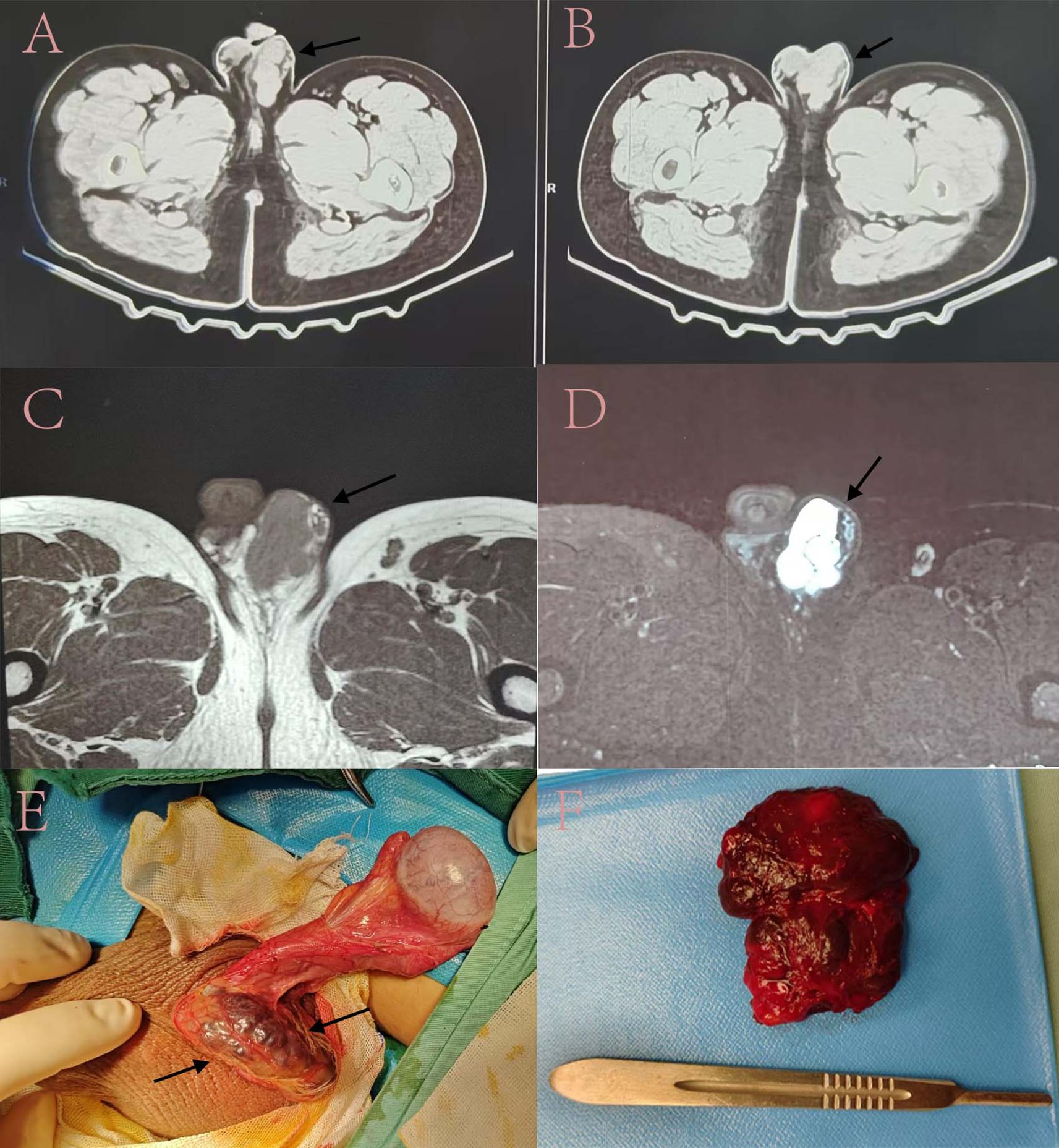 Composite image containing six panels showing medical imagery and surgical procedure: A and B show axial CT scans with large masses near the coccyx indicated by arrows. C and D display MRI images highlighting the lesions with arrows. E depicts a surgical procedure where a mass connected to the coccyx is exposed. F shows the excised mass placed next to a scalpel for scale.
