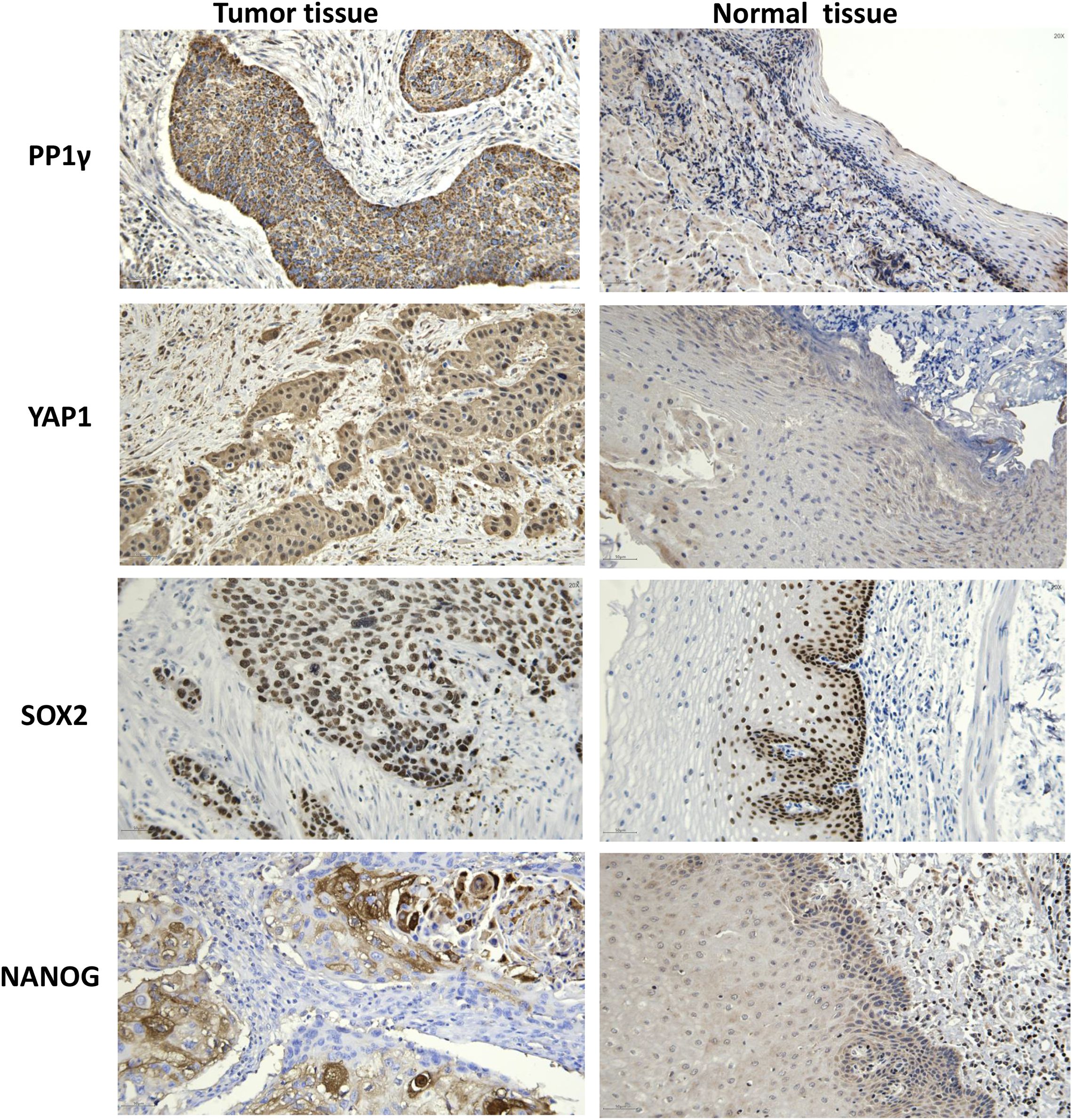 Immunohistochemistry staining images showing expression levels of four proteins: PP1γ, YAP1, SOX2, and NANOG in tumor and normal tissue. Tumor tissue images display dark brown staining, indicating higher protein expression, while normal tissue images show lighter staining, indicating lower expression levels. Each protein is shown in a side-by-side comparison between tumor and normal tissues.