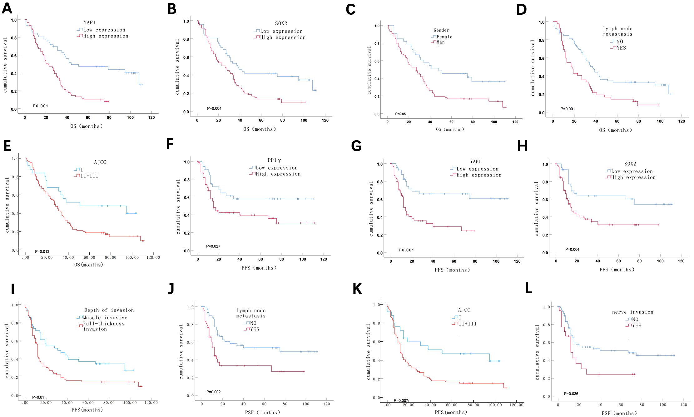 Twelve Kaplan-Meier survival curves labeled A to L show cumulative survival probabilities over time. Each graph compares groups based on factors like expression levels, gender, lymph node metastasis, AJCC classification, depth of invasion, and nerve invasion. Curves are color-coded, and P-values indicate statistical significance, with high expression or more advanced classifications generally associated with lower survival.