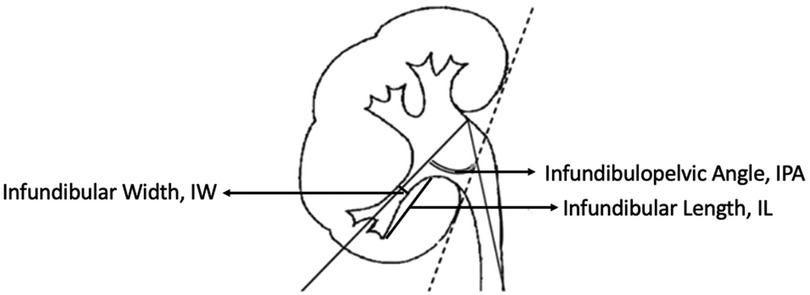 Illustration of a kidney highlighting measurements. Infundibular Width (IW), Infundibular Length (IL), and Infundibulopelvic Angle (IPA) are marked with arrows, showing positions in renal anatomy.