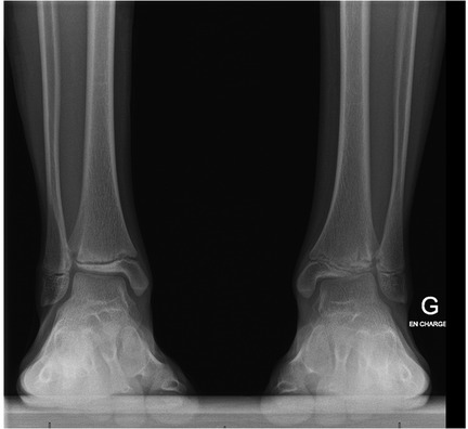 X-ray of a person's lower legs showing the tibia and fibula bones, with the ankles positioned on a flat surface. The bones appear healthy and aligned.