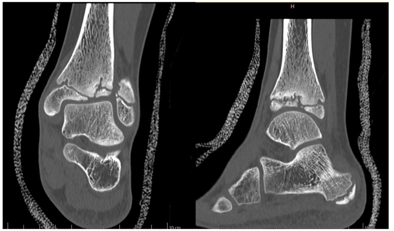 X-ray images depict a human ankle from different angles, showcasing the bone structure and joints. The left image shows a coronal view, while the right image provides a sagittal view, highlighting the bones clearly.