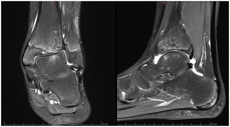 MRI images of an ankle joint, showing different views. The left panel displays a frontal view of the bones and soft tissues, while the right panel shows a side profile, highlighting anatomical details and structures.