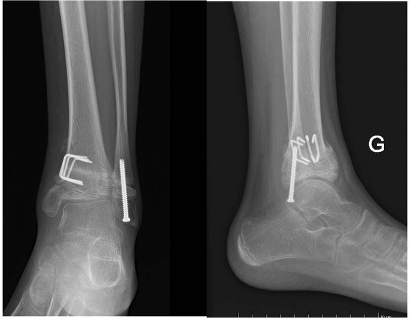 X-ray images of an ankle showing the side and front views. Both images display surgical hardware, including screws and metal plates, securing the bones. The right image is labeled with the letter \