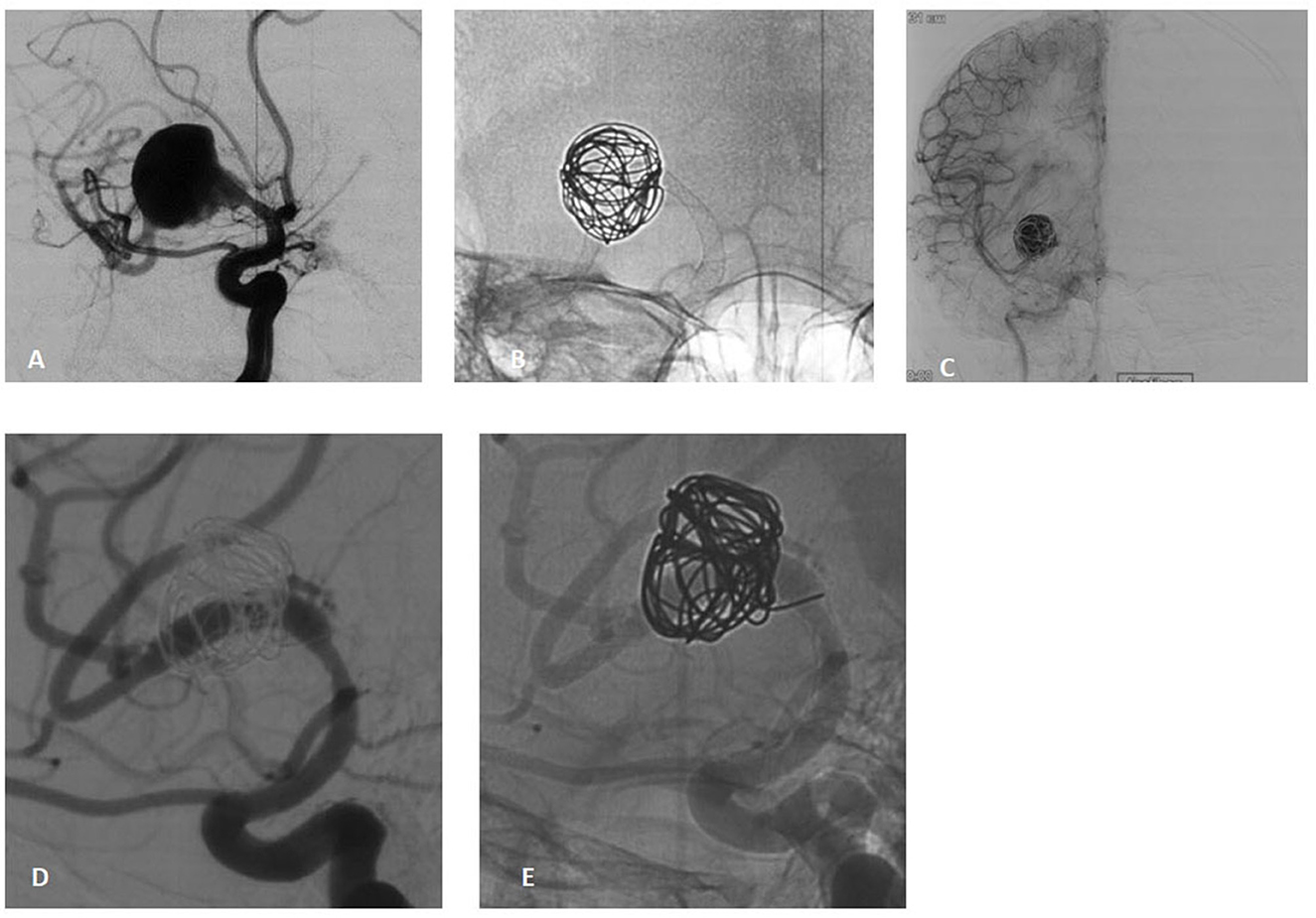 Angiographic images depicting cerebral aneurysm coiling procedures. (A) Shows an unruptured cerebral aneurysm with a large sac. (B) Displays coil insertion into the aneurysm sac. (C) Depicts the aneurysm post-coiling, showing reduced blood flow. (D, E) Illustrate different views of successful coiling, highlighting coil mass stability within the aneurysm.