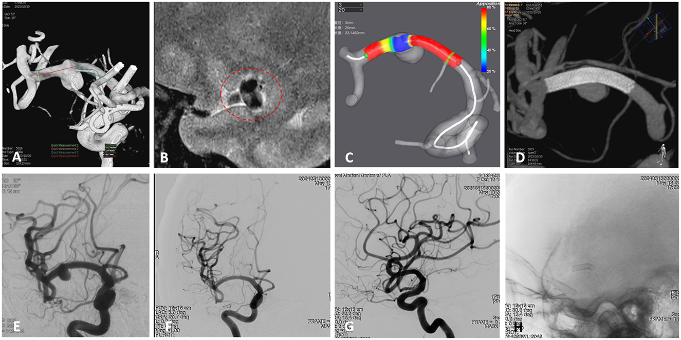A series of medical images showing various views and analyses of cerebral vasculature. (A) Displays a 3D reconstruction of blood vessels. (B) Shows a close-up with a circled area highlighting a feature. (C) Presents a color-coded flow simulation on a vascular model. (D) Depicts another 3D rendering of the vessels. (E–H) Include angiographic images capturing different angles and contrasts of cerebral arteries, demonstrating blood flow and vessel structure.