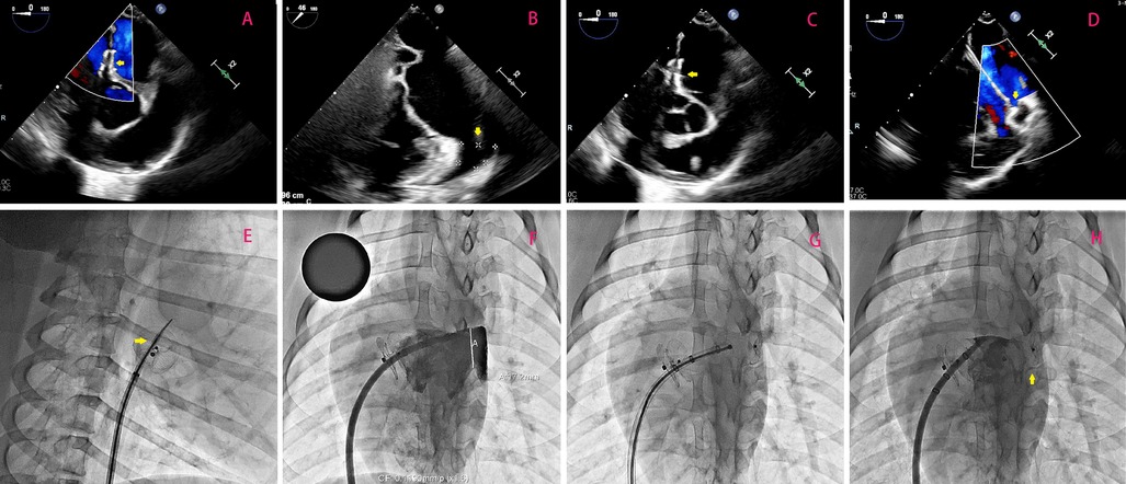 Ultrasound images labeled A to D display colored and grayscale views of cardiac structures with arrows indicating specific features. x-ray images labeled E to H show details of cardiac procedures, including catheter placement, with arrows highlighting significant points.
