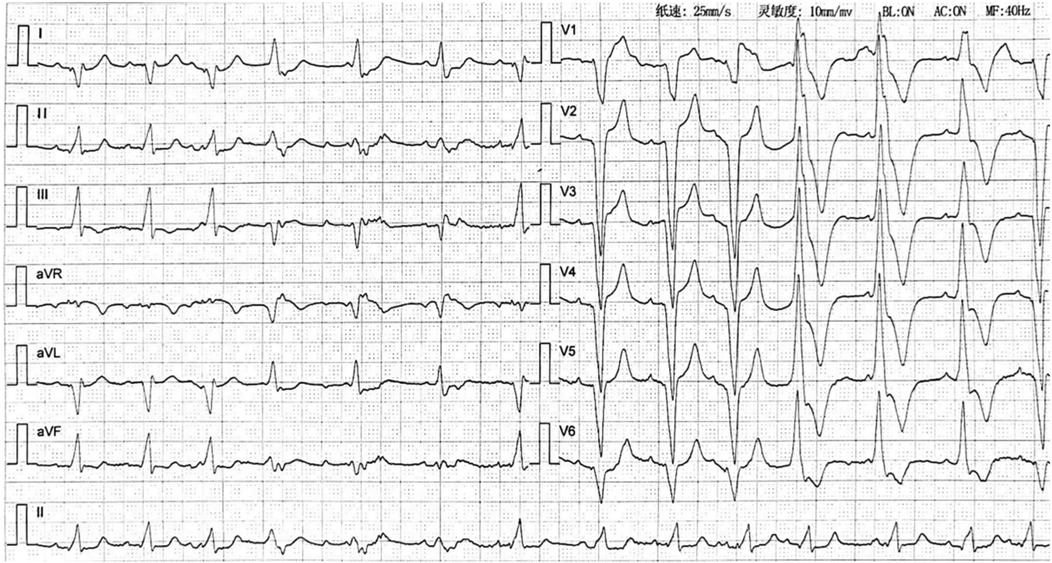 Electrocardiogram showing multiple leads (I, II, III, aVR, aVL, aVF, V1-V6) with each tracing depicting heart electrical activity over time. The recording speed is 25 millimeters per second and the sensitivity is 10 millimeters per millivolt, with filters for baseline, alternating current, and muscle noise applied.