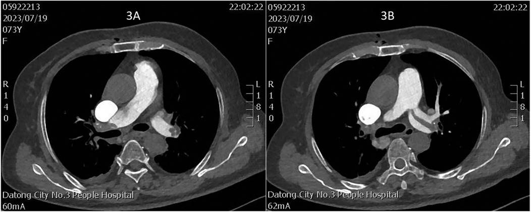 Two CT scan images labeled 3A and 3B show cross-sectional views of the chest, highlighting internal anatomical structures. Both scans display details of bones, soft tissues, and visible contrasts in the chest cavity, conducted at Datong City No. 3 People Hospital.