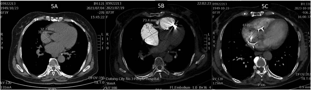 CT scan images labeled 5A, 5B, and 5C show cross-sections of the chest area. Image 5A displays measurements of 37.2 millimeters by 31.3 millimeters. Image 5B has a highlighted area measuring 73.4 millimeters by 51.5 millimeters. Image 5C shows a region with dimensions of 43.0 millimeters by 42.2 millimeters. The scans show various soft tissues, bones, and potential abnormalities indicated by measurements.